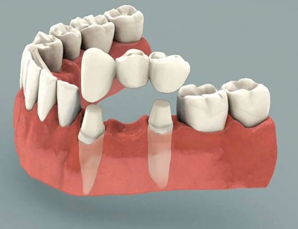 Dental bridge treatment in Chennai – Smile Life Dental offering tooth replacement solutions, missing teeth restoration, and affordable dental crowns