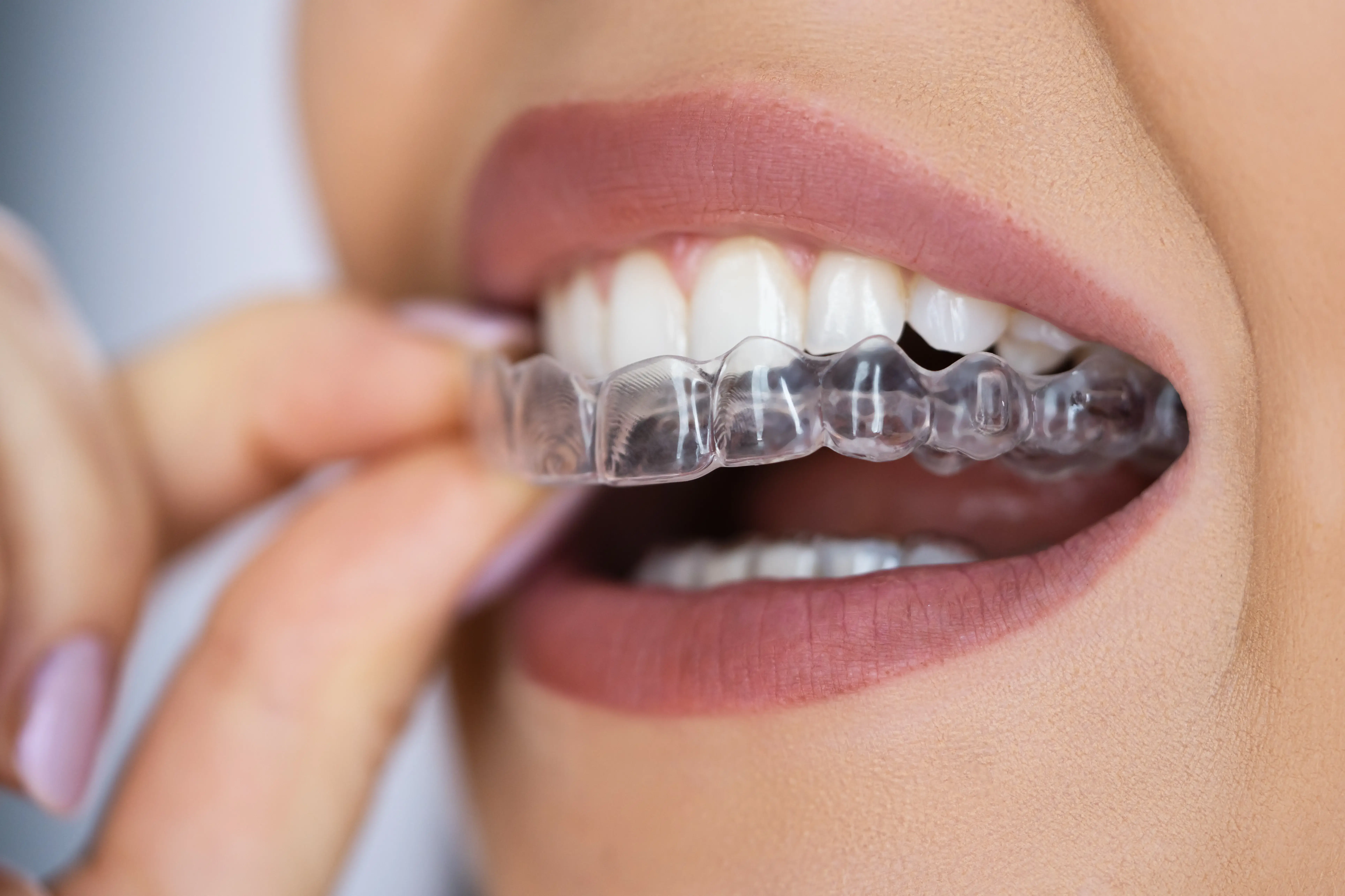 Invisalign treatment in Chennai – Smile Life Dental Clinic offering clear aligners for teeth straightening, affordable Invisalign cost, and advanced orthodontic care