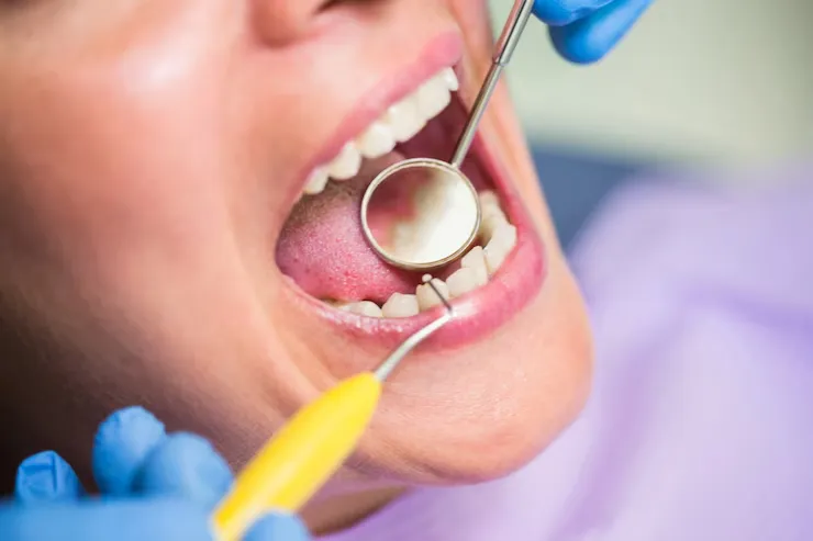 Teeth cleaning in Chennai – Smile Life Dental providing professional dental cleaning, plaque removal, and oral hygiene treatments for healthy gums and cavity prevention