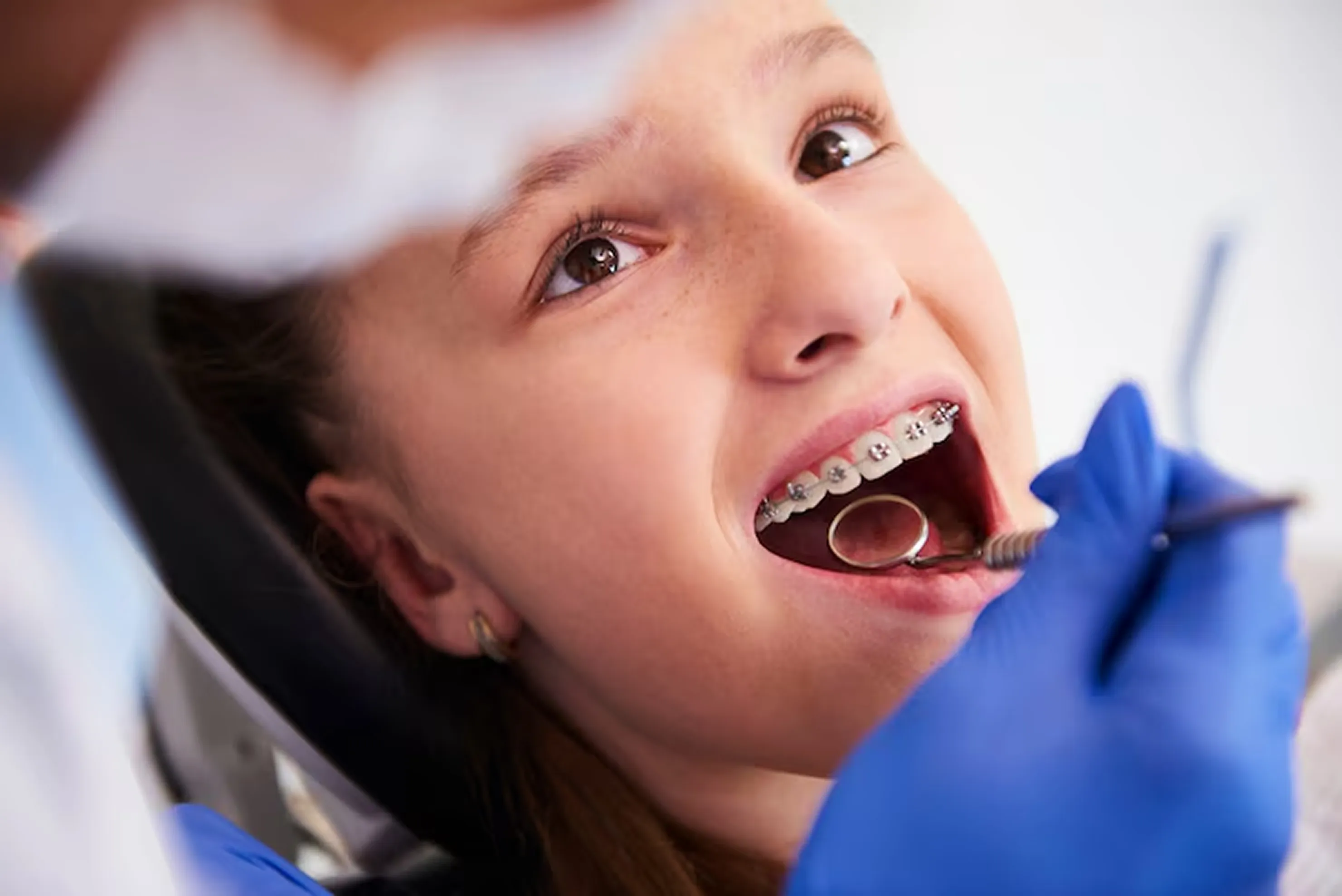 Braces treatment in Chennai – Smile Life Dental providing advanced orthodontic care, teeth straightening, and affordable dental braces for kids and adults